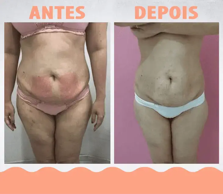 AntesDepois-LipoEnzimática