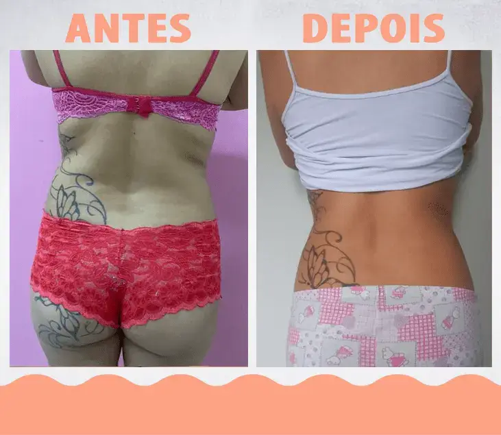 AntesDepois-LipoEnzimática03