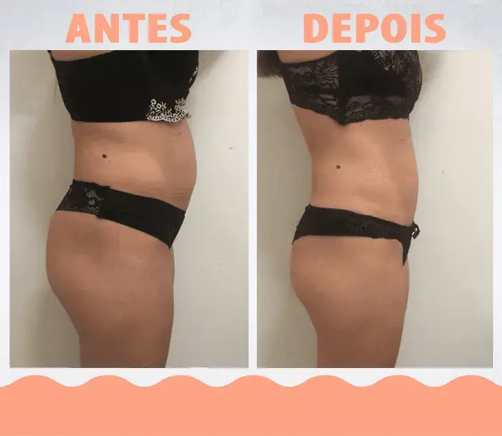 AntesDepois-LipoEnzimática04