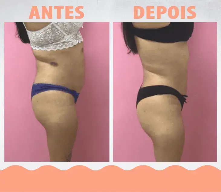 AntesDepois-LipoEnzimática05