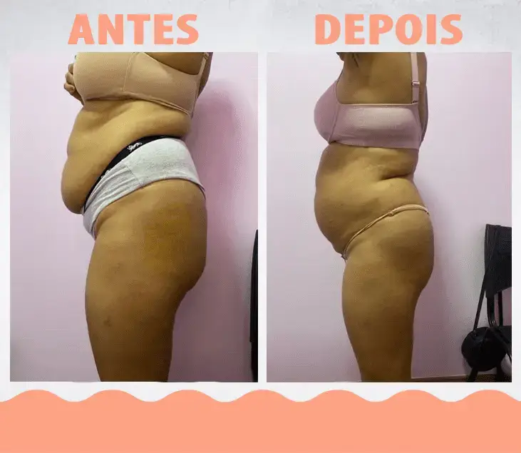 AntesDepois-LipoEnzimática07