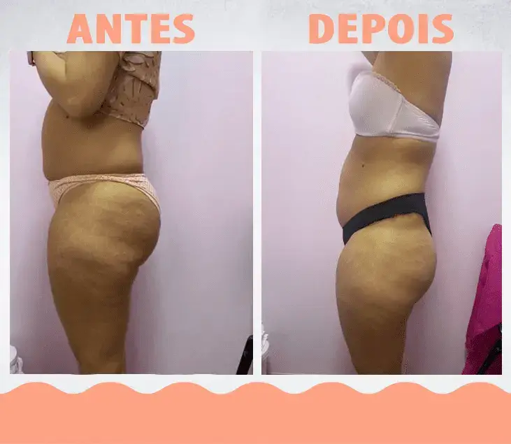 AntesDepois-LipoEnzimática08